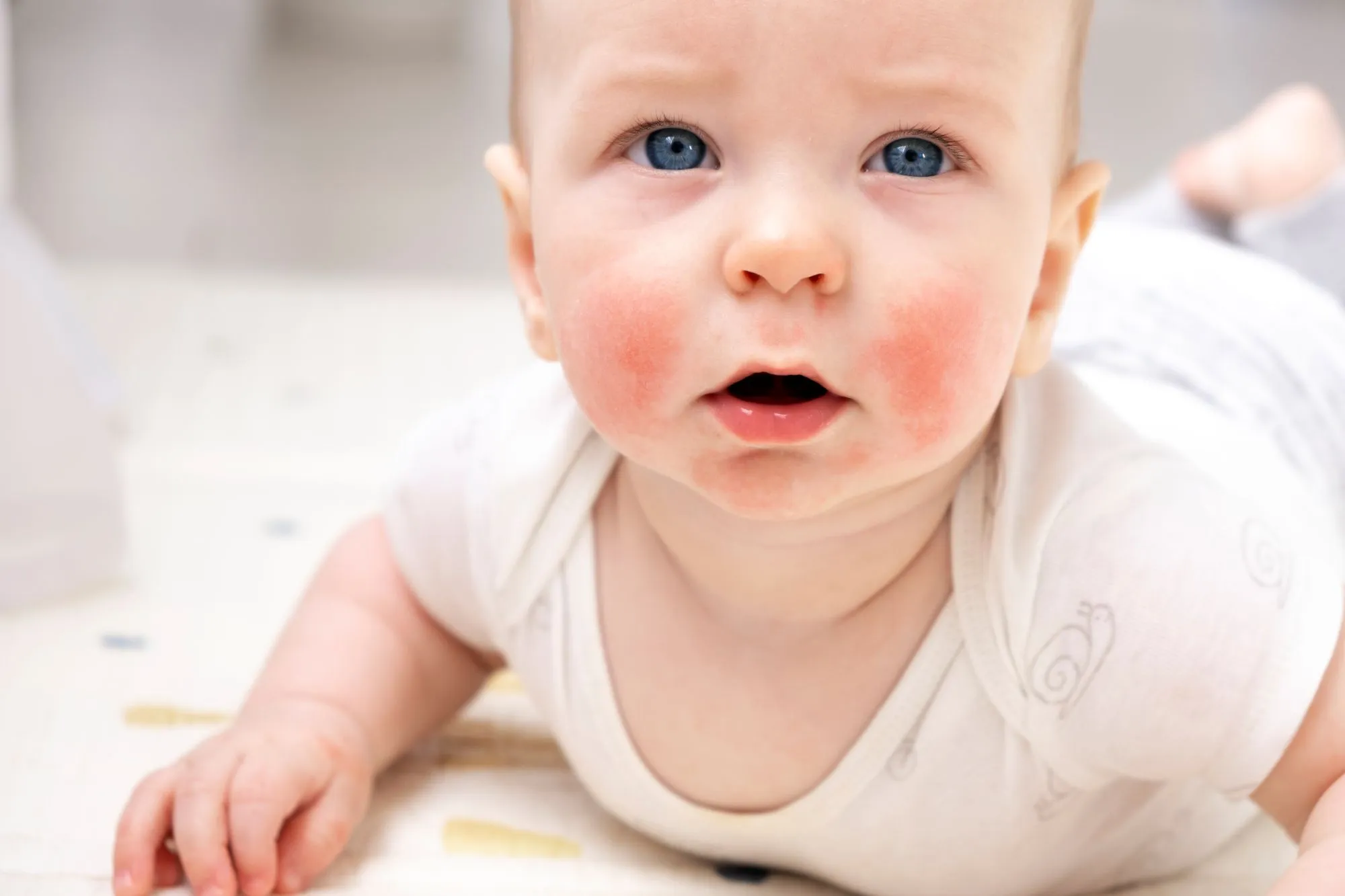 Baby Eczema Causes & Treatment | Eczema in Babies and Children